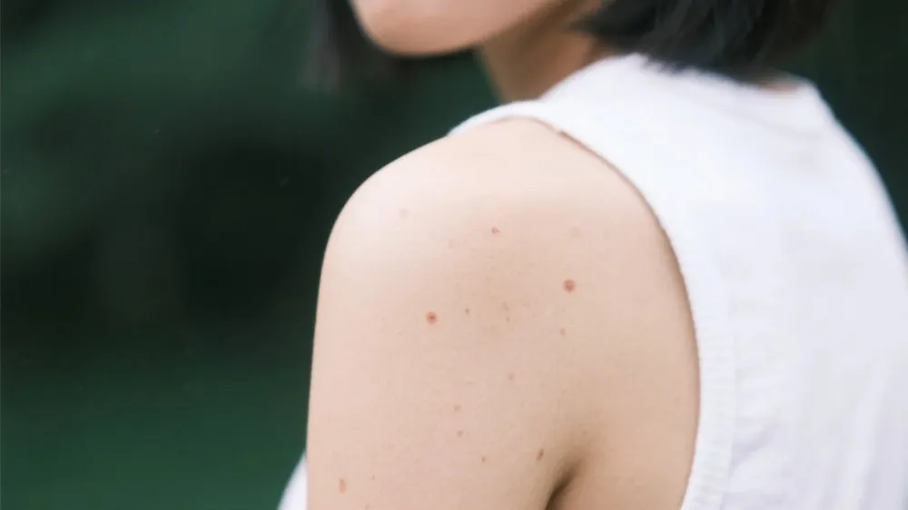 痣